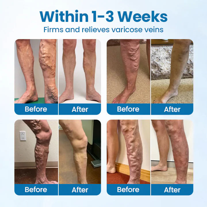 VeinGuard Herbal Spray✅ Clinically proven to eliminate varicose veins in just 7 days!