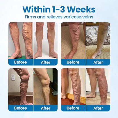 VeinGuard Herbal Spray✅ Clinically proven to eliminate varicose veins in just 7 days!