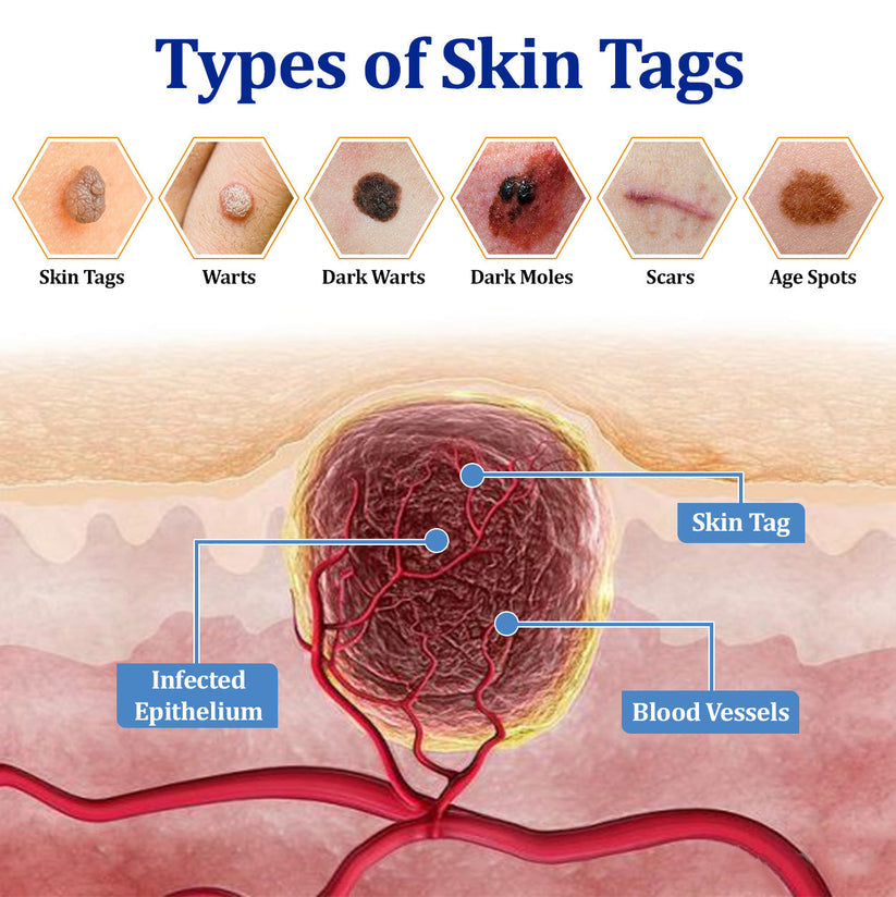 👩‍⚕️ BeeDerm RX Cream, Painless, easy and gentle fix for warts, skin tags, lumps, infections, cysts and scars🎁