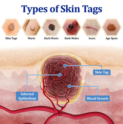 👩‍⚕️ BeeDerm RX Cream, Painless, easy and gentle fix for warts, skin tags, lumps, infections, cysts and scars🎁