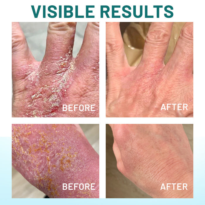 🎅 Early Christmas Sale 🎄 Probiotic + B 24-7 Moisture Eczema Relief Cream