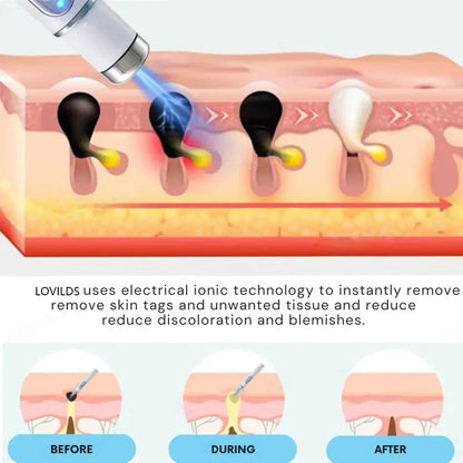 🔥【OFFICIAL STORE】 Non-Invasive Mole and Wart Removal Laser Pen