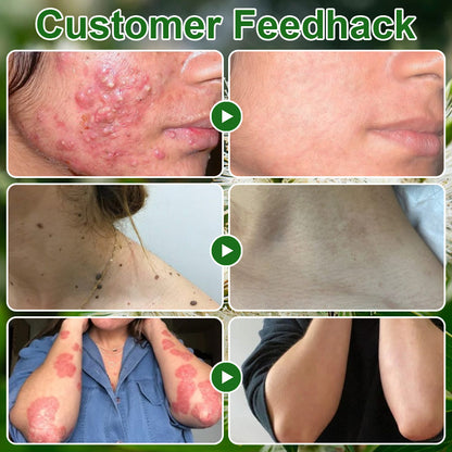 🔥𝐓𝐞𝐚 𝐓𝐫𝐞𝐞 𝐎𝐢𝐥 𝐒𝐤𝐢𝐧 𝐓𝐫𝐞𝐚𝐭𝐦𝐞𝐧𝐭 𝐂𝐫𝐞𝐚𝐦✅𝐅𝐃𝐀-𝐀𝐏𝐏𝐑𝐎𝐕𝐄𝐃 – Removes Skin Blemishes, Repairs Damaged Skin, Brightens & Anti-Ageing Care