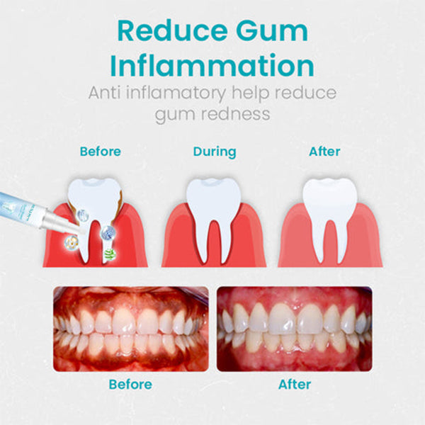 Gum Shield Therapy Gel