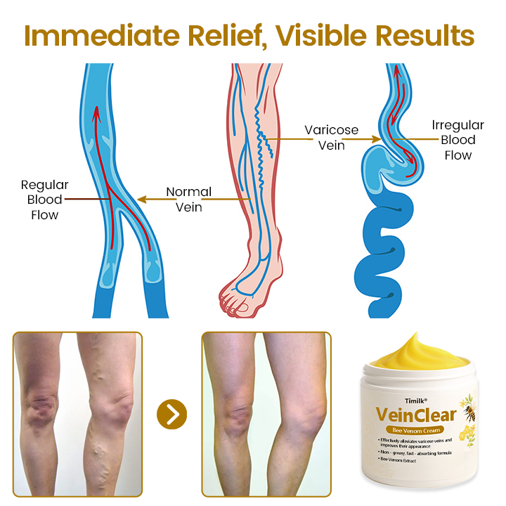 VeinClear Bee Venom Cream |✨ Visible Relief in Just 7 Days! 🦵🌿