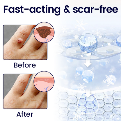 WartErase Cryo Freeze Spray