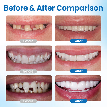 🔥Last day:50% off🔥 SmileMend Tooth Repair Filling Kit