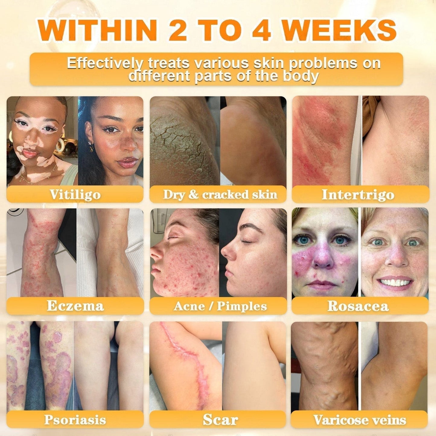 🐝🔥FDA Approved|BEE toxin Skin Restoration Cream (Anti-aging, Hydrating, Skin Repair, Even Tone, Acne and Dark Spot Treatment, Wart and Mole Removal, Psoriasis Relief)