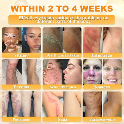 🐝🔥FDA Approved|BEE toxin Skin Restoration Cream (Anti-aging, Hydrating, Skin Repair, Even Tone, Acne and Dark Spot Treatment, Wart and Mole Removal, Psoriasis Relief)