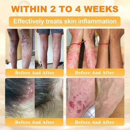 🐝🔥FDA Approved|BEE toxin Skin Restoration Cream (Anti-aging, Hydrating, Skin Repair, Even Tone, Acne and Dark Spot Treatment, Wart and Mole Removal, Psoriasis Relief)