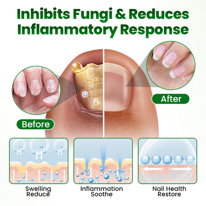 🔥Last day:70% off🔥 HerbaNail 7-Day Repair Serum 🔥 FDA Certified (Clinically Proven Herbal Formula for 7-Day Nail Fungus Repair & Strength Restoration 🌿)