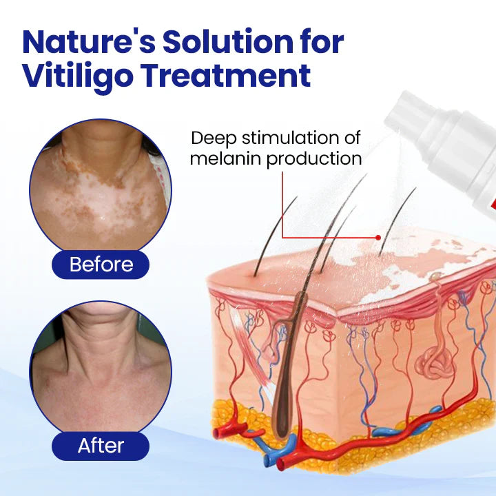✅Official Store | Vitiligo Treatment Spray