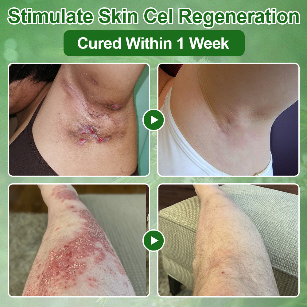 🔥𝐓𝐞𝐚 𝐓𝐫𝐞𝐞 𝐎𝐢𝐥 𝐒𝐤𝐢𝐧 𝐓𝐫𝐞𝐚𝐭𝐦𝐞𝐧𝐭 𝐂𝐫𝐞𝐚𝐦✅𝐅𝐃𝐀-𝐀𝐏𝐏𝐑𝐎𝐕𝐄𝐃 – Removes Skin Blemishes, Repairs Damaged Skin, Brightens & Anti-Ageing Care