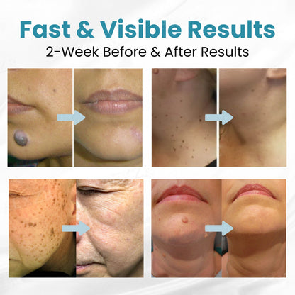 🔥【OFFICIAL STORE】 Non-Invasive Mole and Wart Removal Laser Pen