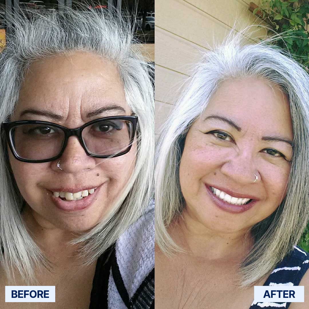 AdaptableFit Functional Dentures – Made in the USA & FDA-Certified