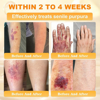 🐝🔥FDA Approved|BEE toxin Skin Restoration Cream (Anti-aging, Hydrating, Skin Repair, Even Tone, Acne and Dark Spot Treatment, Wart and Mole Removal, Psoriasis Relief)