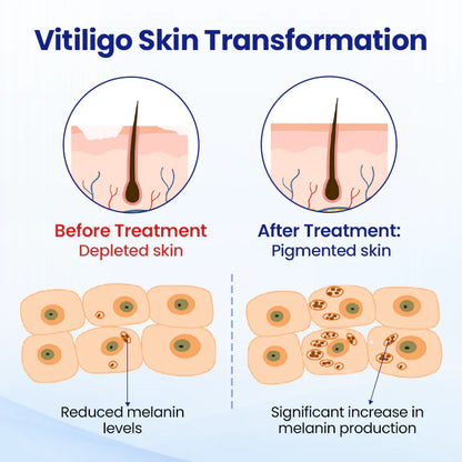 ✅Official Store | Vitiligo Treatment Spray
