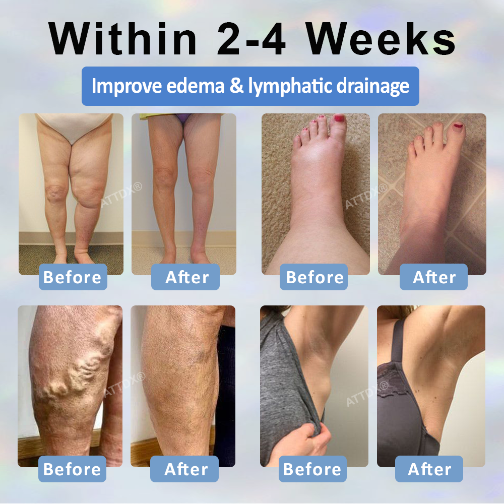 Black Cumin Edema Soothing Herbal Cream -👩‍⚕️Doctor-Endorsed Herbal Formula