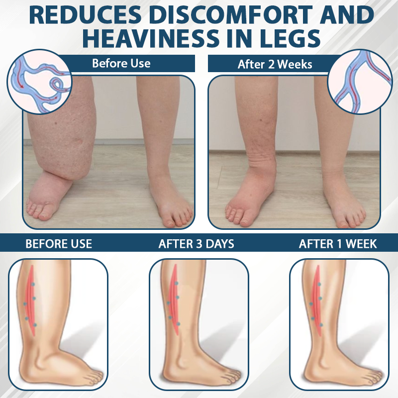 Black Cumin Edema Soothing Herbal Cream -👩‍⚕️Doctor-Endorsed Herbal Formula