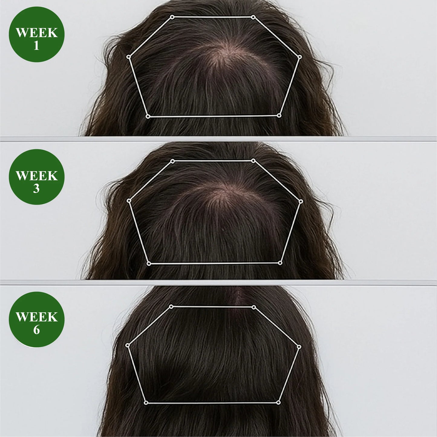 HairFuse Micro-Infusion Hair Regrowth Kit