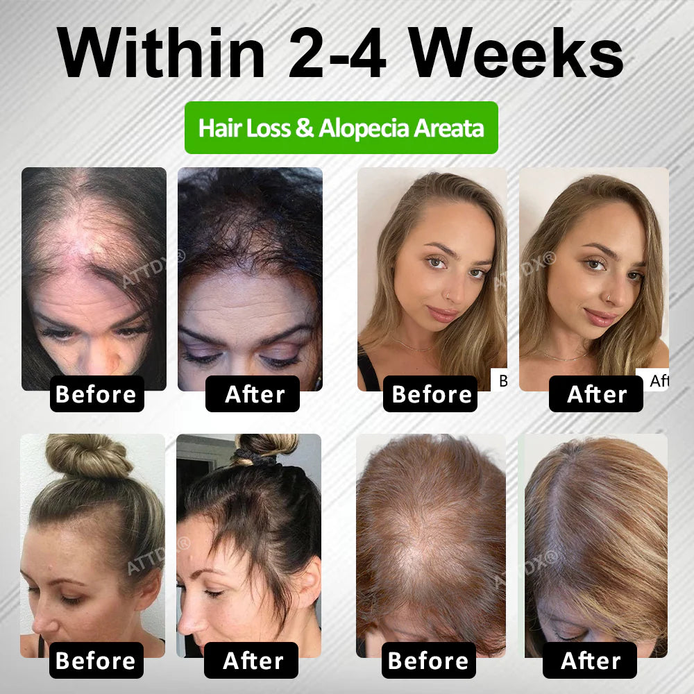 HairFuse Micro-Infusion Hair Regrowth Kit