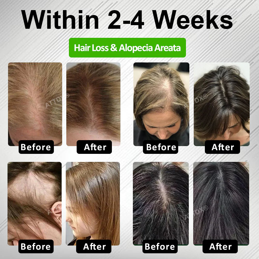 HairFuse Micro-Infusion Hair Regrowth Kit