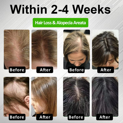 HairFuse Micro-Infusion Hair Regrowth Kit