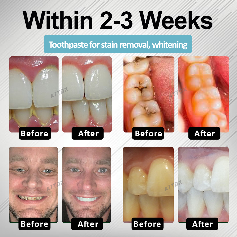 🔥TikTok Hot Sellers- MaxNHA Whitening Repair Toothpaste