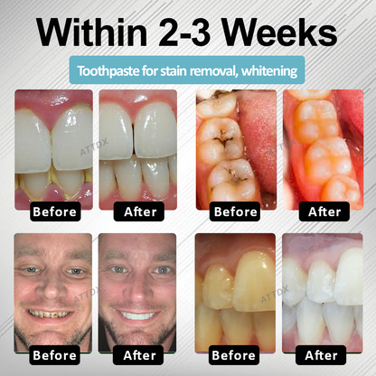 🔥TikTok Hot Sellers- MaxNHA Whitening Repair Toothpaste