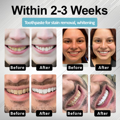 🔥TikTok Hot Sellers- MaxNHA Whitening Repair Toothpaste