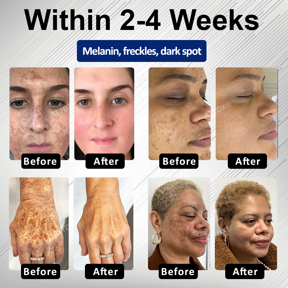🔥TikTok Hot Sellers- ATTDX® Melano+ 377 Whitening & Spot Cream