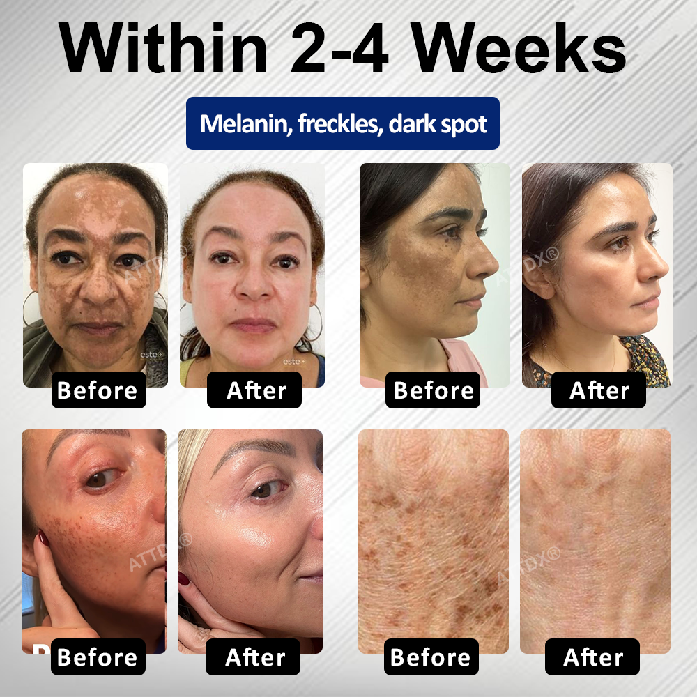 🔥TikTok Hot Sellers- ATTDX® Melano+ 377 Whitening & Spot Cream