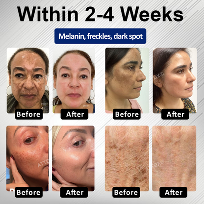 🔥TikTok Hot Sellers- ATTDX® Melano+ 377 Whitening & Spot Cream