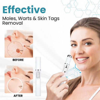 🔥【OFFICIAL STORE】 Non-Invasive Mole and Wart Removal Laser Pen